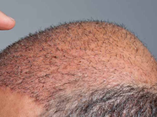 man getting neograft hair transplant