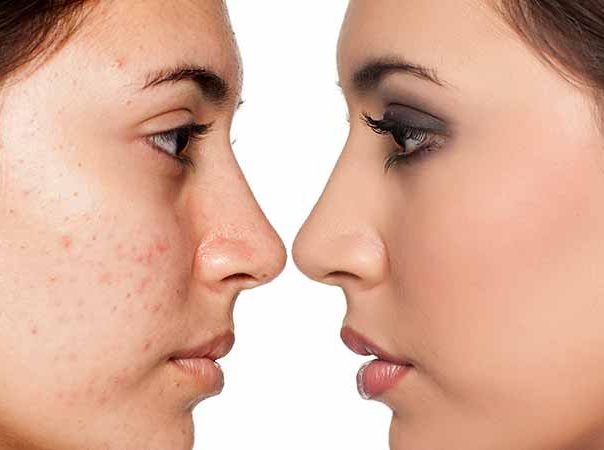patient before and after pelleve