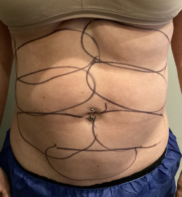 Coolsculpting Before and After | Jack + Jill Aesthetics