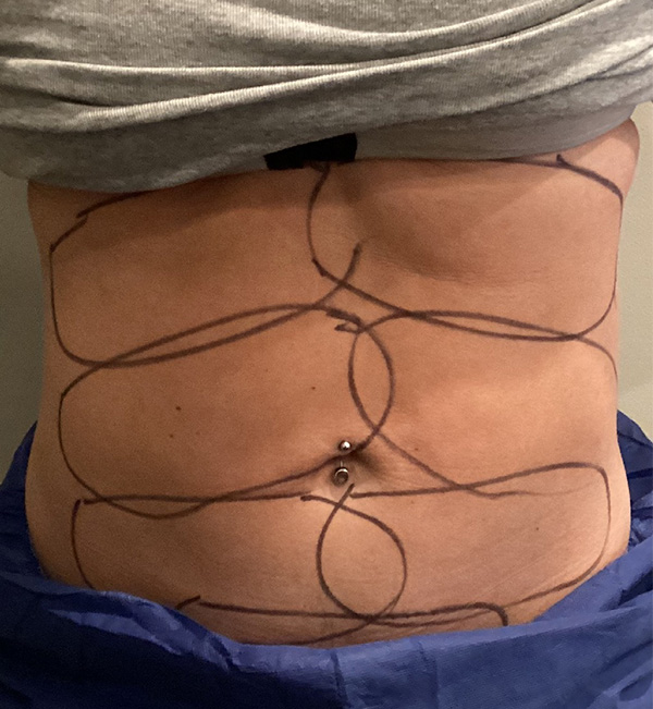 Coolsculpting Before and After | Jack + Jill Aesthetics