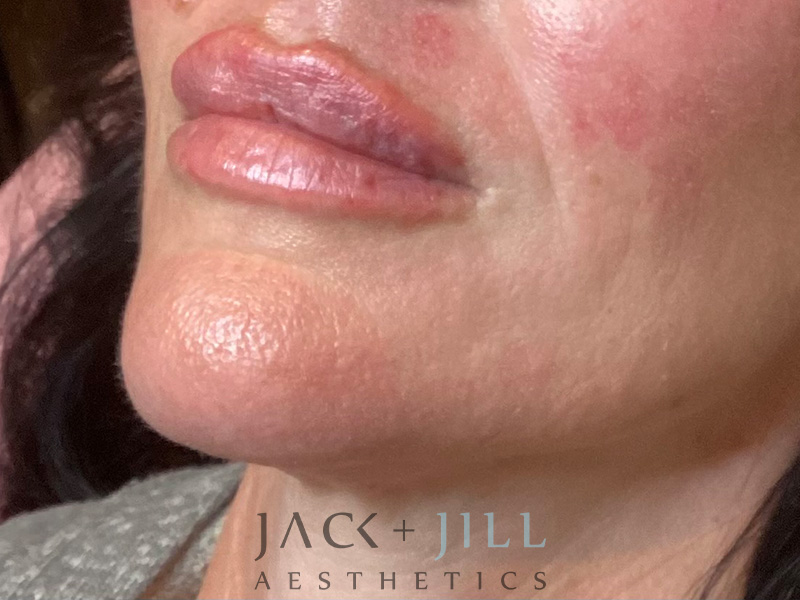 Injectable Fillers And Neurotoxins Before and After | Jack + Jill Aesthetics