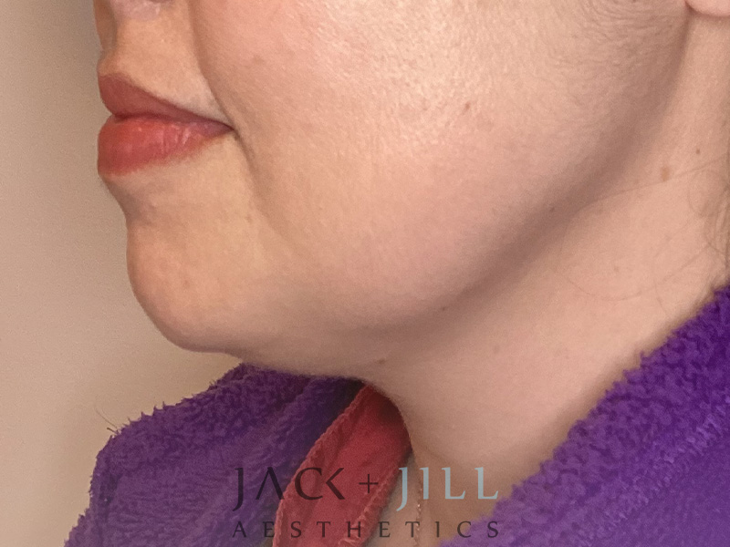 Injectable Fillers And Neurotoxins Before and After | Jack + Jill Aesthetics