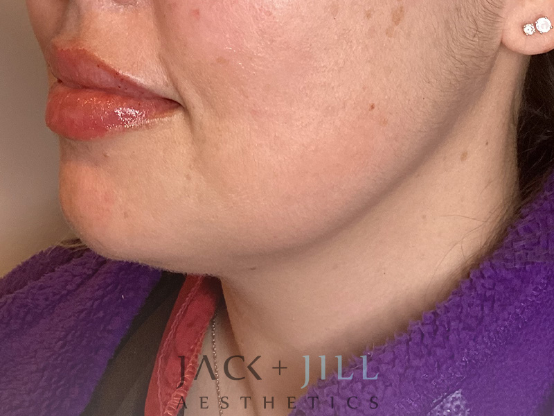 Injectable Fillers And Neurotoxins Before and After | Jack + Jill Aesthetics