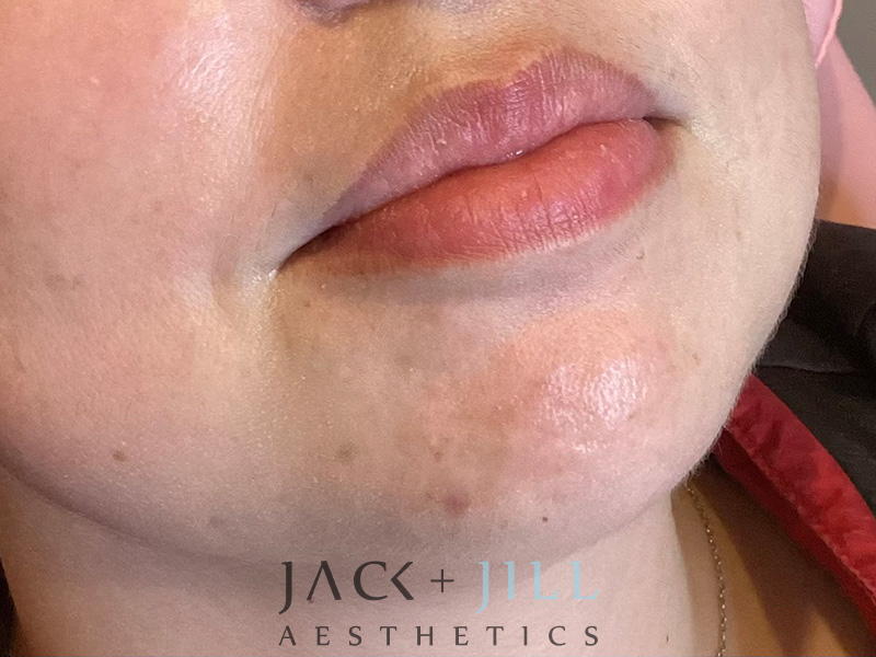 Injectable Fillers And Neurotoxins Before and After | Jack + Jill Aesthetics