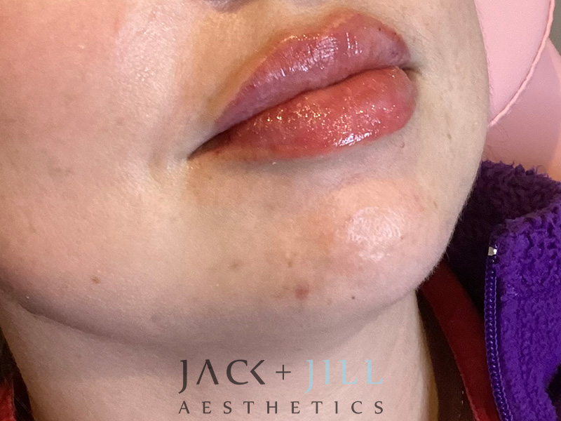 Injectable Fillers And Neurotoxins Before and After | Jack + Jill Aesthetics