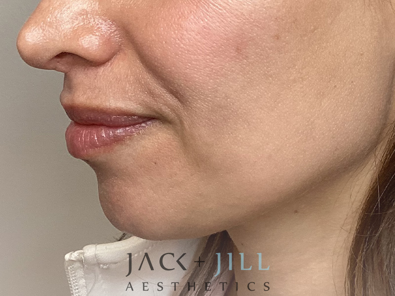 Injectable Fillers And Neurotoxins Before and After | Jack + Jill Aesthetics