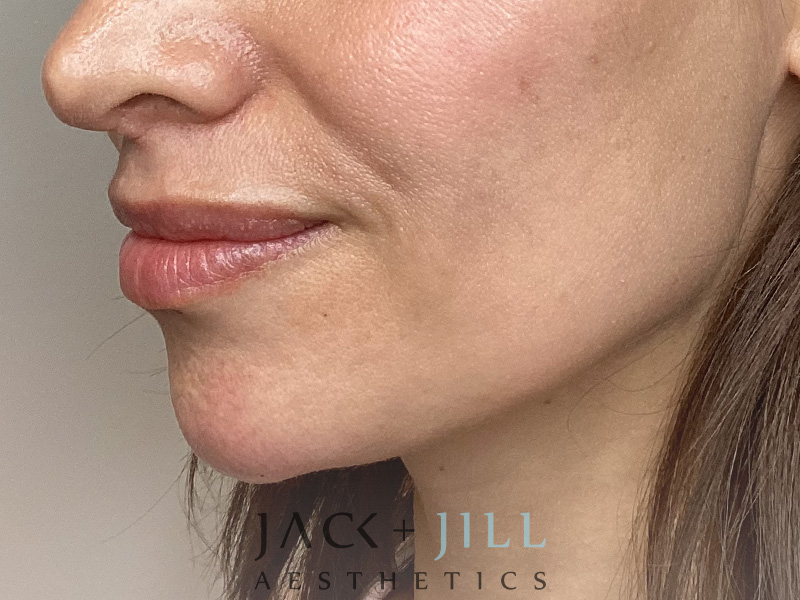 Injectable Fillers And Neurotoxins Before and After | Jack + Jill Aesthetics