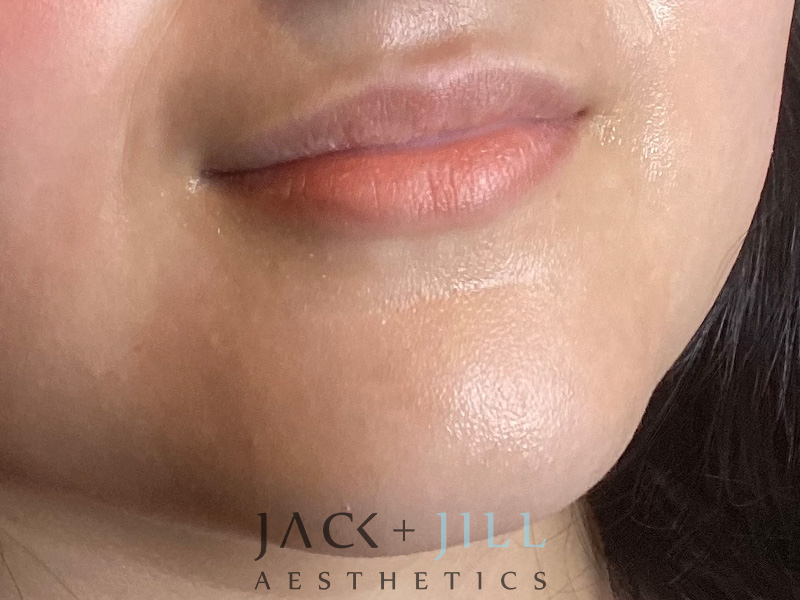 Injectable Fillers And Neurotoxins Before and After | Jack + Jill Aesthetics