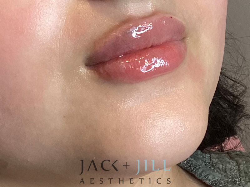 Injectable Fillers And Neurotoxins Before and After | Jack + Jill Aesthetics