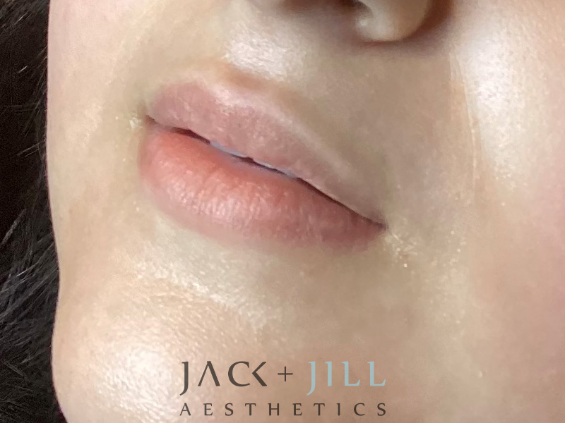 Injectable Fillers And Neurotoxins Before and After | Jack + Jill Aesthetics