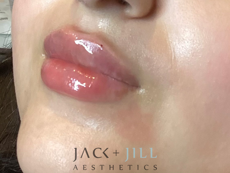 Injectable Fillers And Neurotoxins Before and After | Jack + Jill Aesthetics