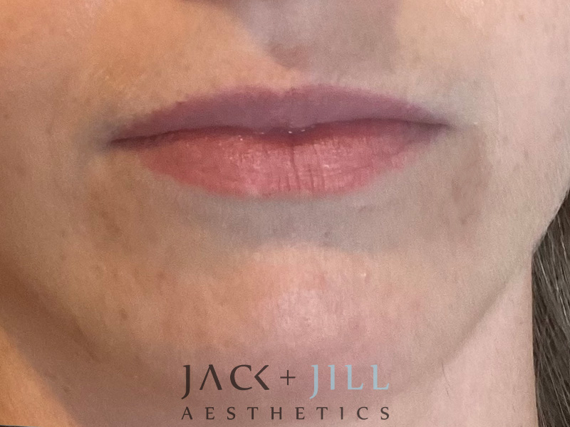 Injectable Fillers And Neurotoxins Before and After | Jack + Jill Aesthetics