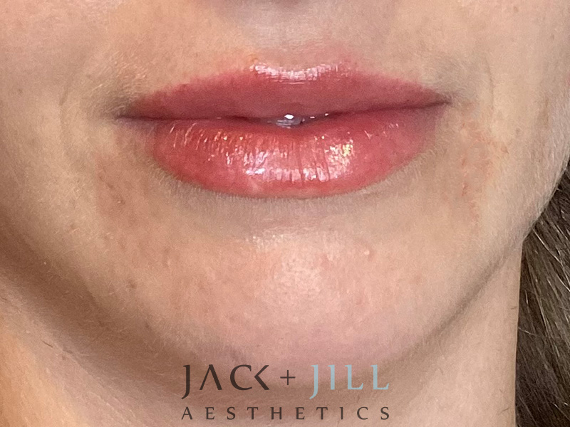 Injectable Fillers And Neurotoxins Before and After | Jack + Jill Aesthetics
