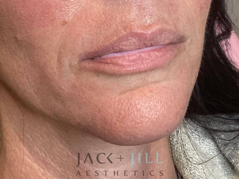Injectable Fillers And Neurotoxins Before and After | Jack + Jill Aesthetics