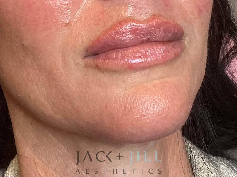 Injectable Fillers And Neurotoxins Before and After | Jack + Jill Aesthetics
