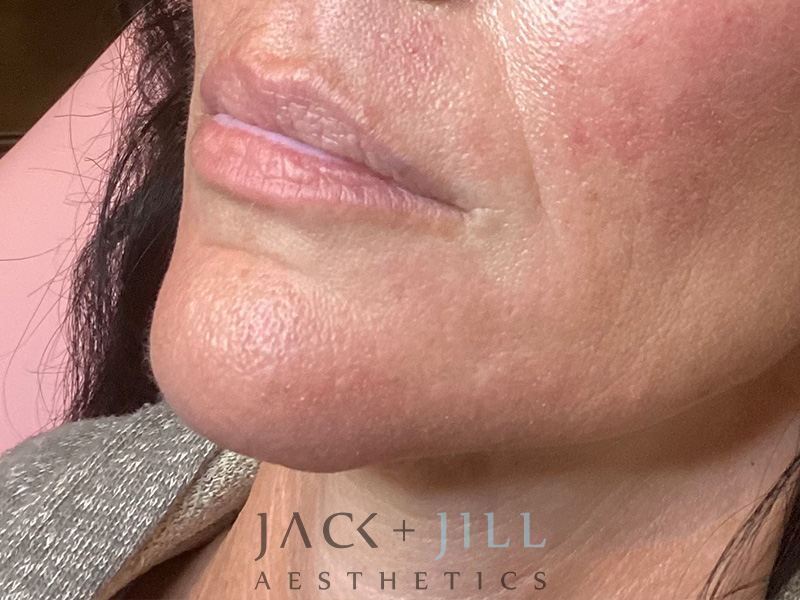 Injectable Fillers And Neurotoxins Before and After | Jack + Jill Aesthetics