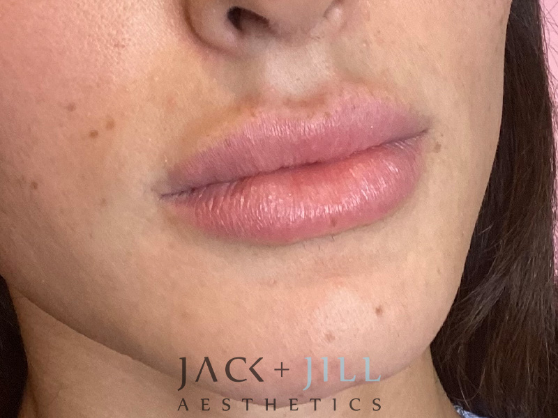 Injectable Fillers And Neurotoxins Before and After | Jack + Jill Aesthetics
