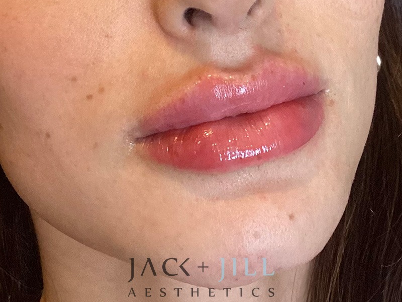 Injectable Fillers And Neurotoxins Before and After | Jack + Jill Aesthetics