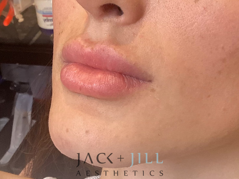 Injectable Fillers And Neurotoxins Before and After | Jack + Jill Aesthetics