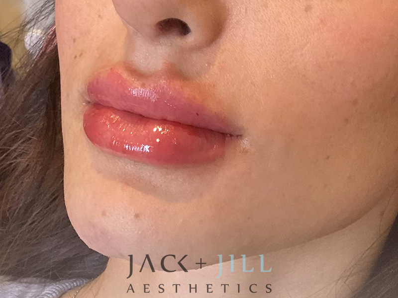 Injectable Fillers And Neurotoxins Before and After | Jack + Jill Aesthetics