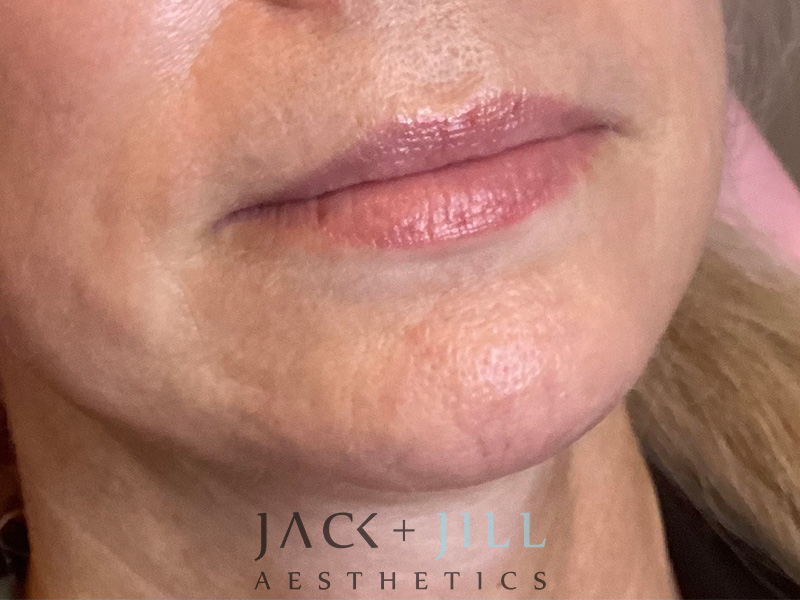 Injectable Fillers And Neurotoxins Before and After | Jack + Jill Aesthetics