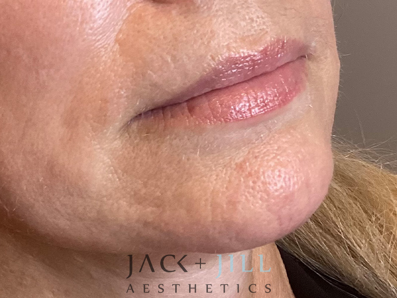 Injectable Fillers And Neurotoxins Before and After | Jack + Jill Aesthetics