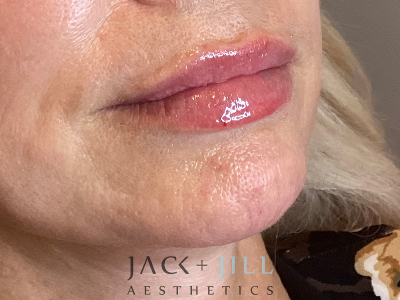Injectable Fillers And Neurotoxins Before and After | Jack + Jill Aesthetics