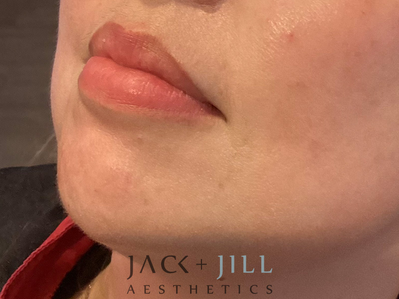 Injectable Fillers And Neurotoxins Before and After | Jack + Jill Aesthetics