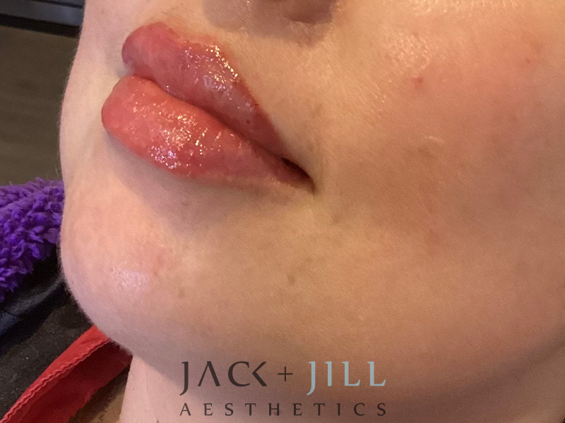 Injectable Fillers And Neurotoxins Before and After | Jack + Jill Aesthetics