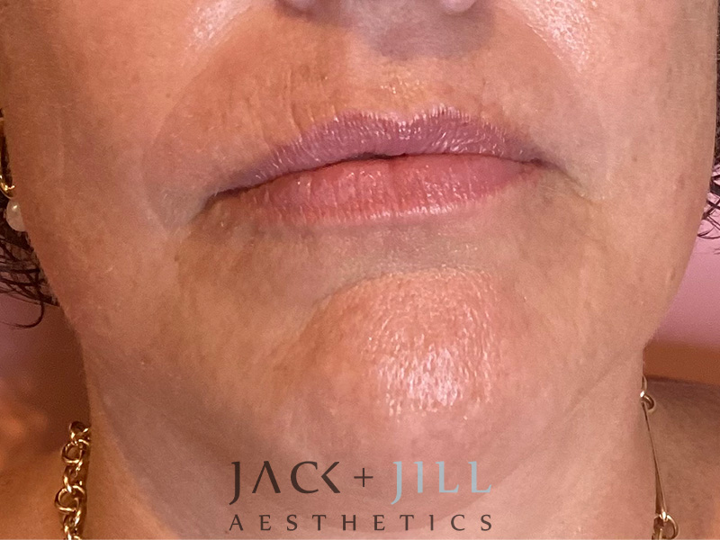 Injectable Fillers And Neurotoxins Before and After | Jack + Jill Aesthetics