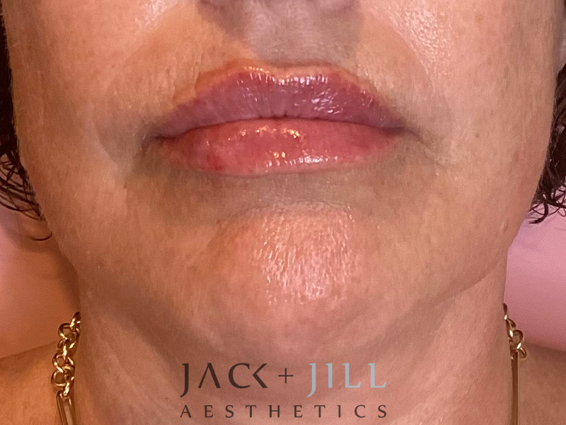 Injectable Fillers And Neurotoxins Before and After | Jack + Jill Aesthetics