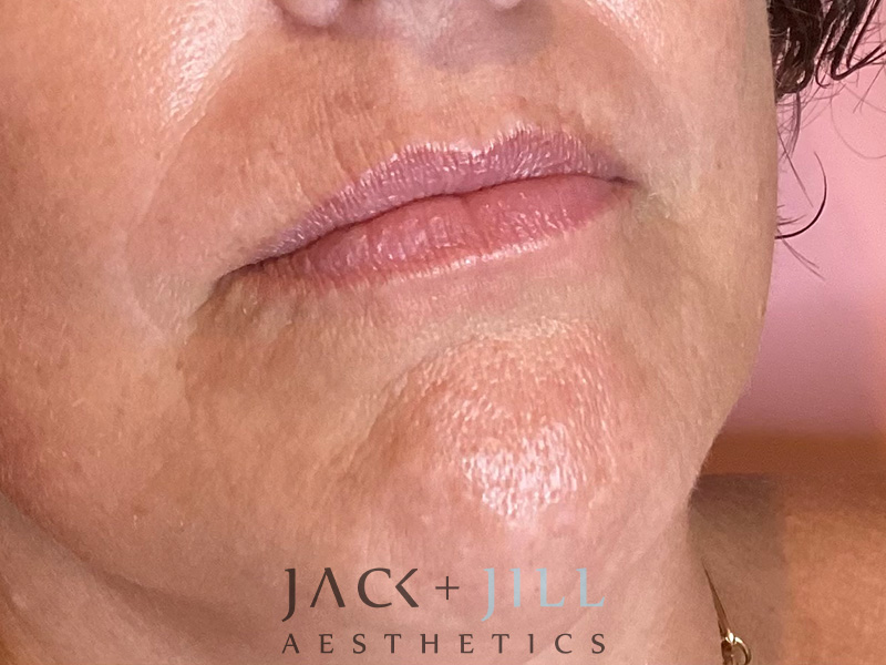 Injectable Fillers And Neurotoxins Before and After | Jack + Jill Aesthetics