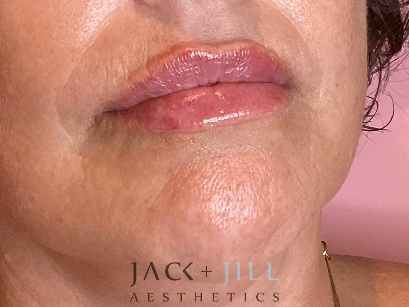 Injectable Fillers And Neurotoxins Before and After | Jack + Jill Aesthetics