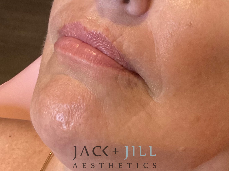 Injectable Fillers And Neurotoxins Before and After | Jack + Jill Aesthetics