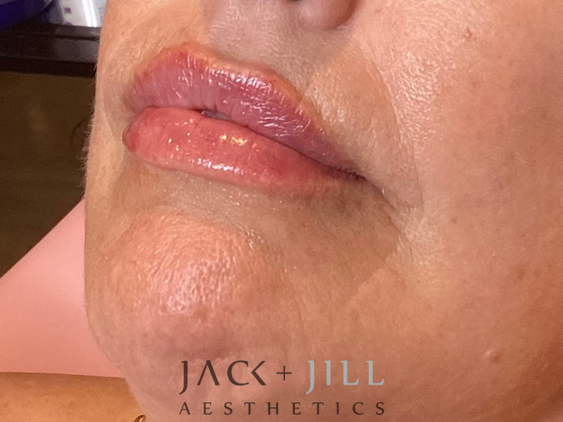 Injectable Fillers And Neurotoxins Before and After | Jack + Jill Aesthetics