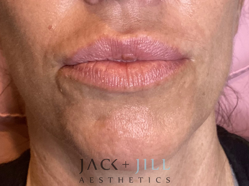 Injectable Fillers And Neurotoxins Before and After | Jack + Jill Aesthetics
