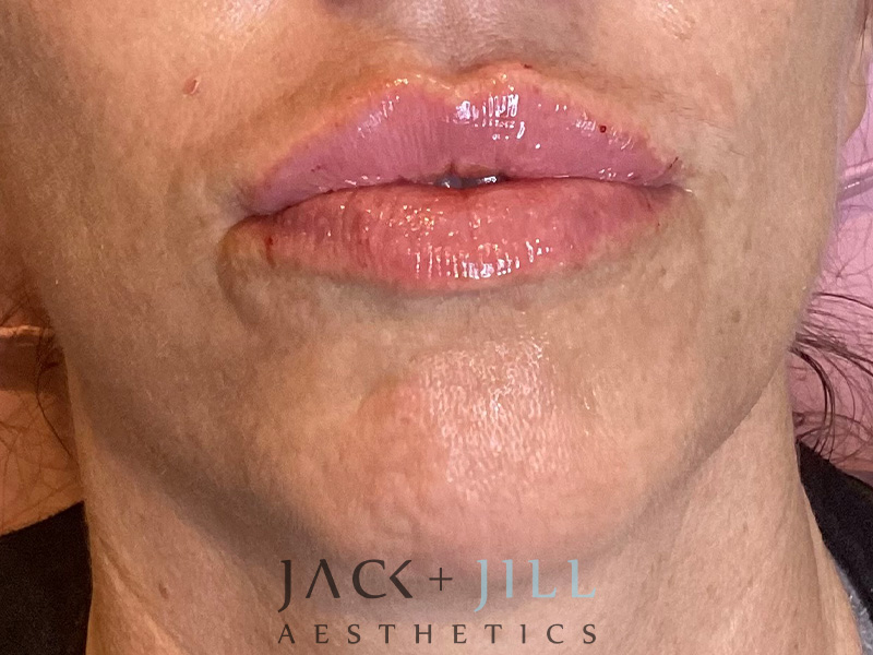 Injectable Fillers And Neurotoxins Before and After | Jack + Jill Aesthetics
