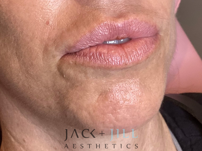 Injectable Fillers And Neurotoxins Before and After | Jack + Jill Aesthetics