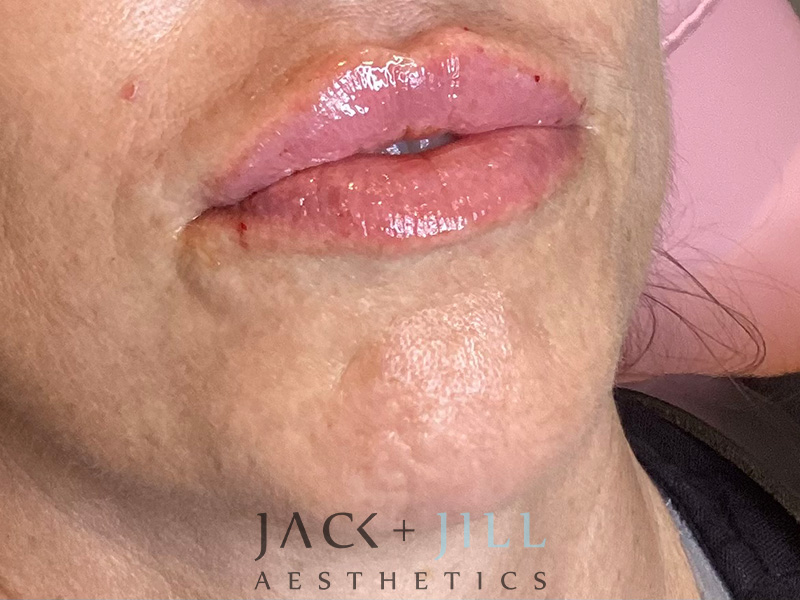 Injectable Fillers And Neurotoxins Before and After | Jack + Jill Aesthetics