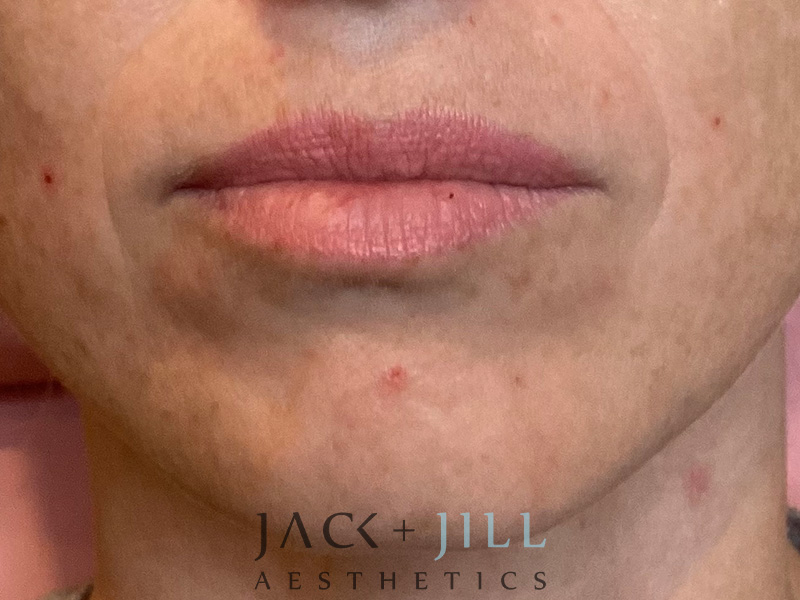 Injectable Fillers And Neurotoxins Before and After | Jack + Jill Aesthetics