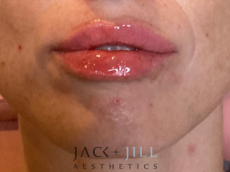 Injectable Fillers And Neurotoxins Before and After | Jack + Jill Aesthetics