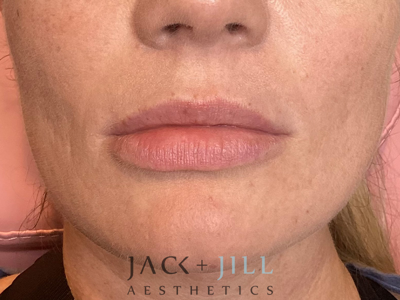 Injectable Fillers And Neurotoxins Before and After | Jack + Jill Aesthetics