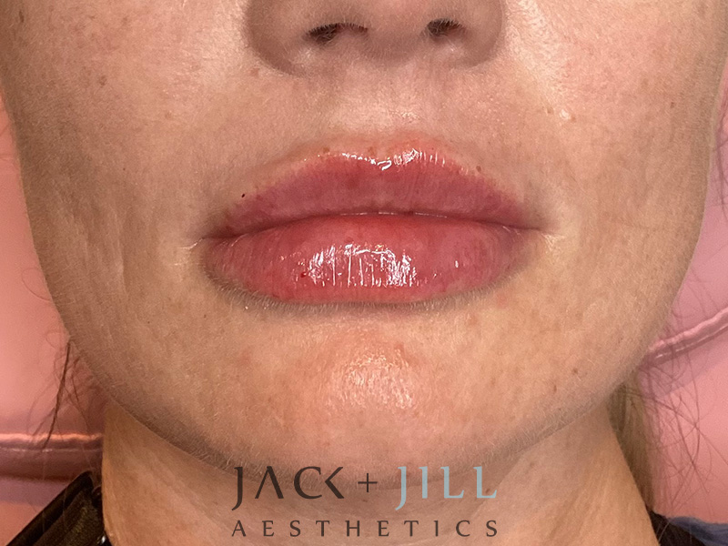 Injectable Fillers And Neurotoxins Before and After | Jack + Jill Aesthetics