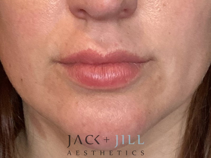 Injectable Fillers And Neurotoxins Before and After | Jack + Jill Aesthetics