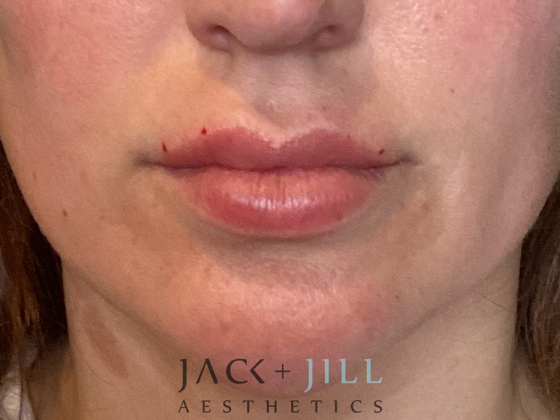 Injectable Fillers And Neurotoxins Before and After | Jack + Jill Aesthetics