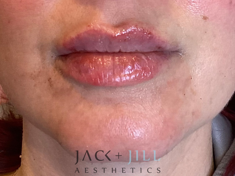 Injectable Fillers And Neurotoxins Before and After | Jack + Jill Aesthetics