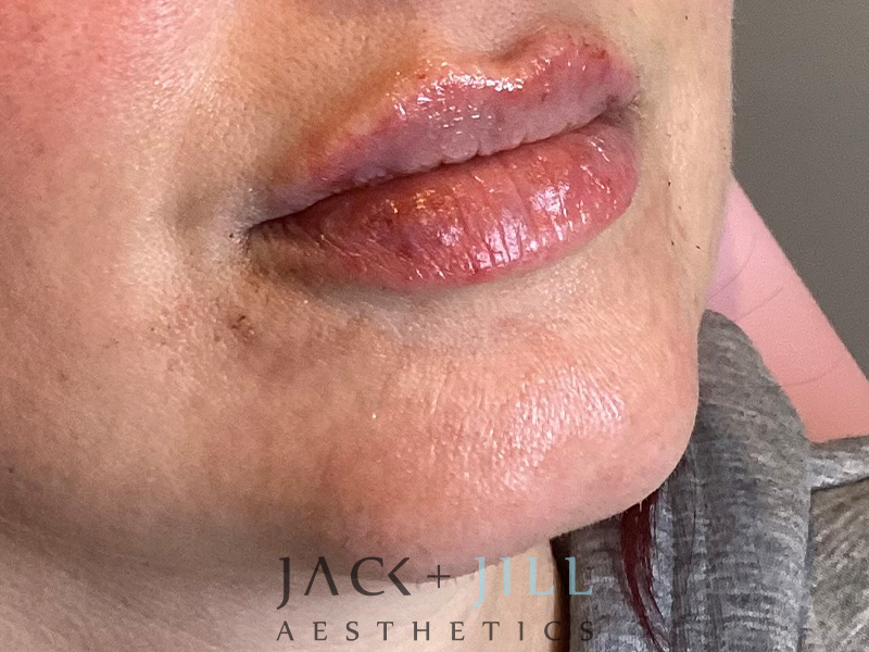 Injectable Fillers And Neurotoxins Before and After | Jack + Jill Aesthetics