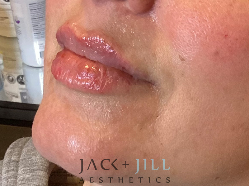 Injectable Fillers And Neurotoxins Before and After | Jack + Jill Aesthetics
