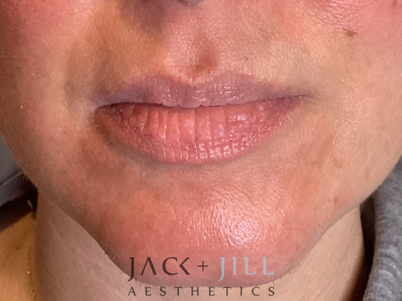 Injectable Fillers And Neurotoxins Before and After | Jack + Jill Aesthetics