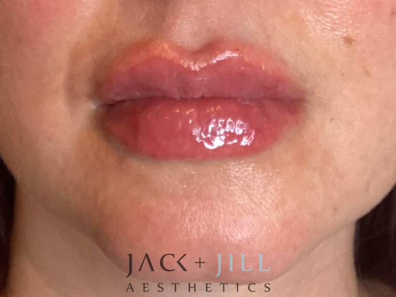 Injectable Fillers And Neurotoxins Before and After | Jack + Jill Aesthetics